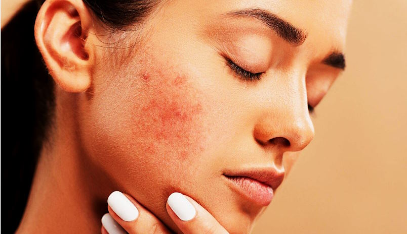 effectively treating acne scars